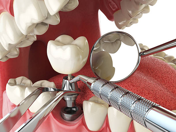 Best Emergency Root Canal Treatment in Kirby, TX